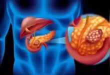 Photo of जल्दी पहचान में नहीं आते पैंक्रियाटिक कैंसर के लक्षण