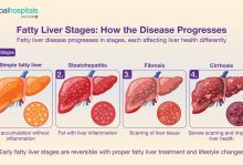 Photo of NAFLD Symptoms: फैटी लिवर की समस्या आजकल काफी आम हो रही है। खास बात यह है कि शुरुआती दौर में ज्यादातर लोगों को इसके कोई स्पष्ट लक्षण महसूस नहीं होते???